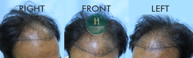 Hairline Designing 3500